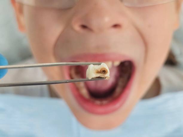 Best Emergency Dental Care for Sports Injuries in Decherd, TN